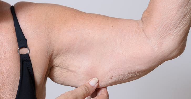 Flabby Arm